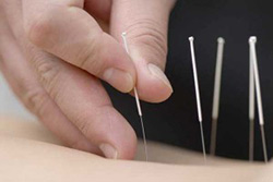 Acupuncture needles on the back